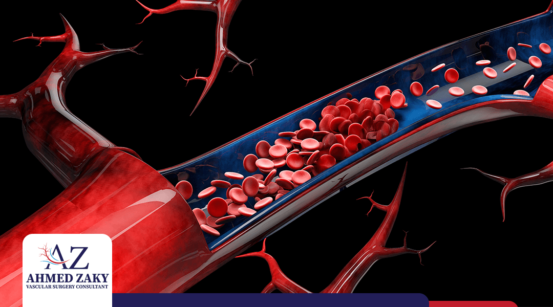 تمدد الأوعية الدموية | الأسباب والأنواع ودرجة الخطورة