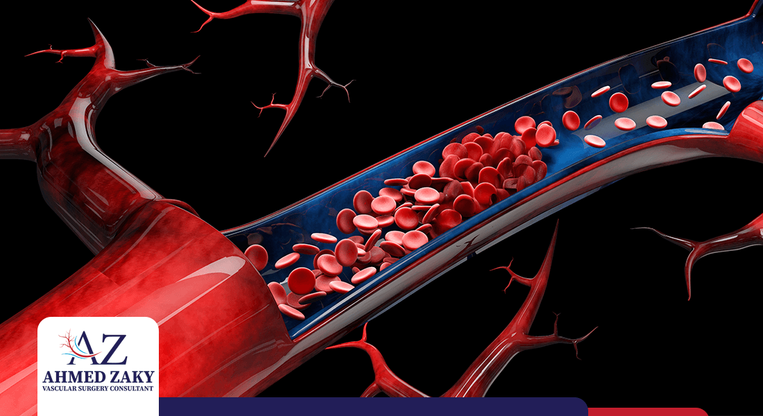 تمدد-الاوعية-الدموية تمدد الأوعية الدموية