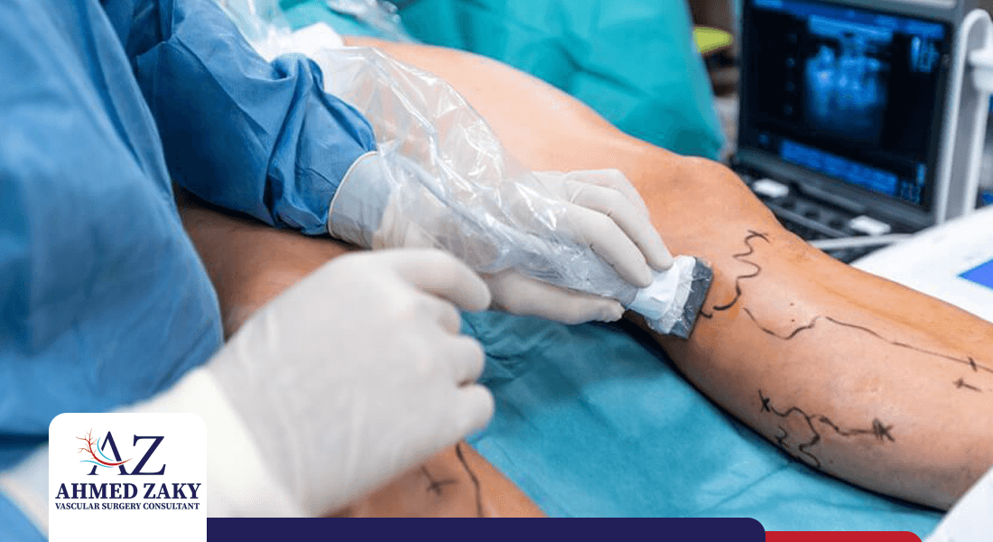 عملية-الدوالي-بالليزر عملية الدوالي بالليزر