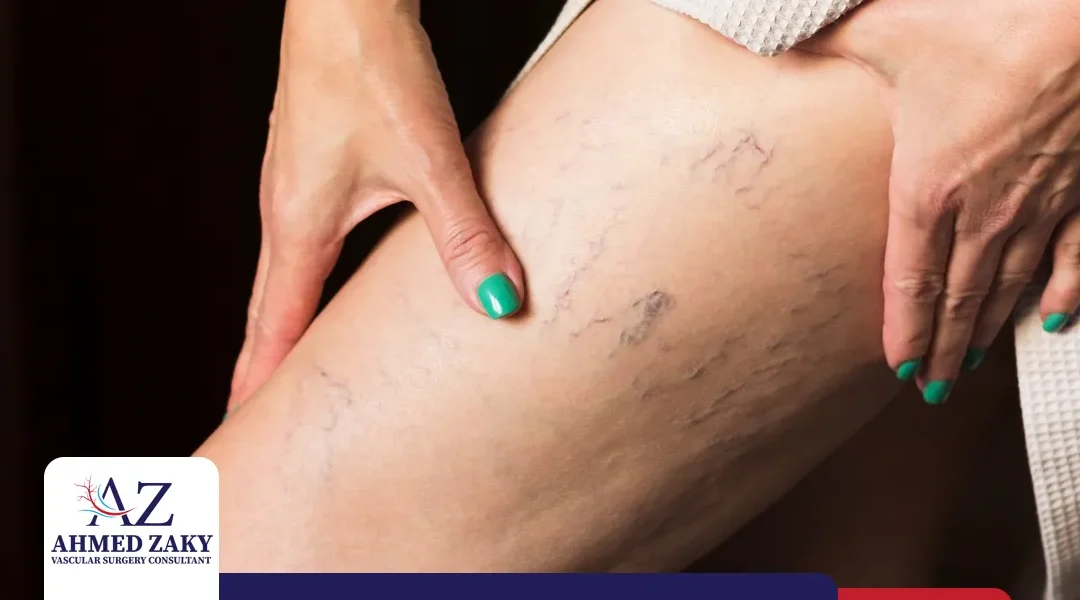 أسباب دوالي الساقين عند النساء وكيفية الوقاية منها