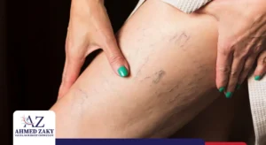 أسباب دوالي الساقين عند النساء