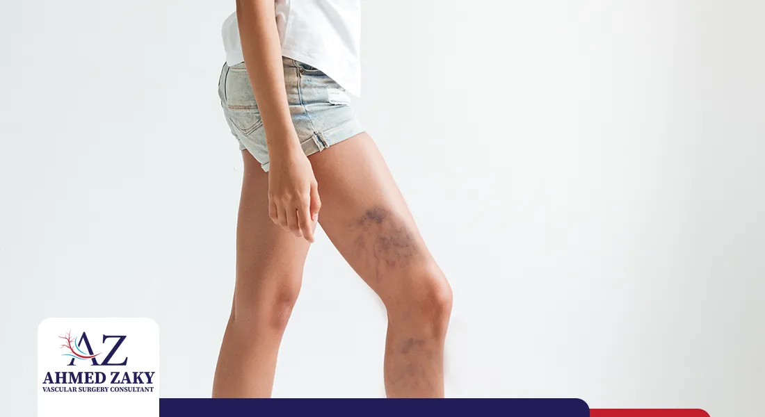 أسباب ظهور الدوالي في سن مبكر | 5