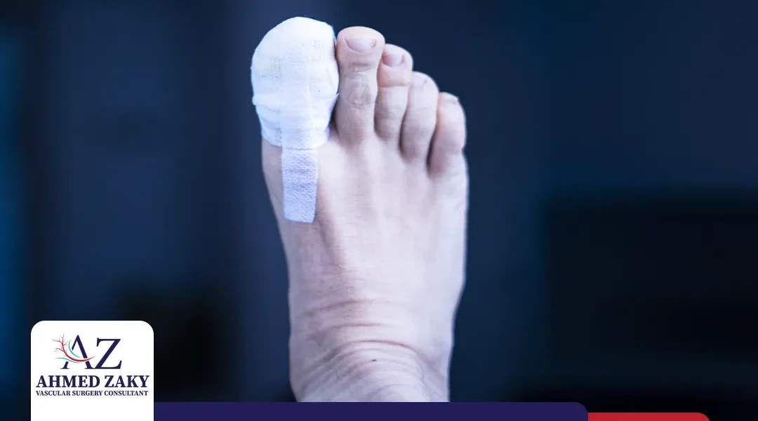 مضاعفات بتر إصبع القدم السكري | الأسباب والعلاج