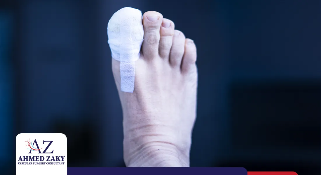 مضاعفات-بتر-إصبع-القدم-السكري مضاعفات بتر إصبع القدم السكري