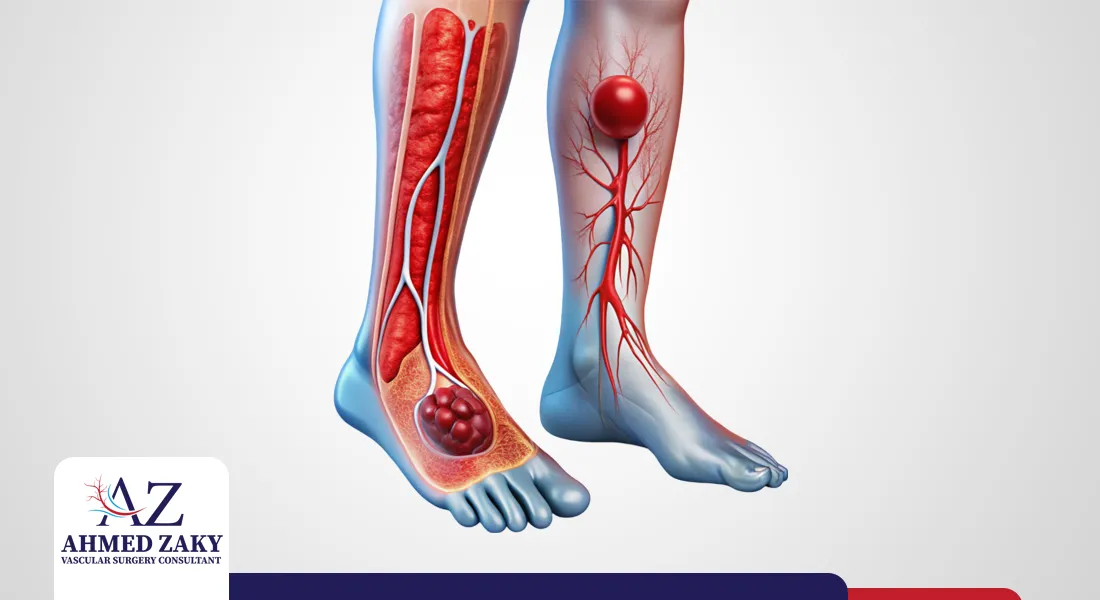 الفرق بين جلطة الساق وجلطة القدم