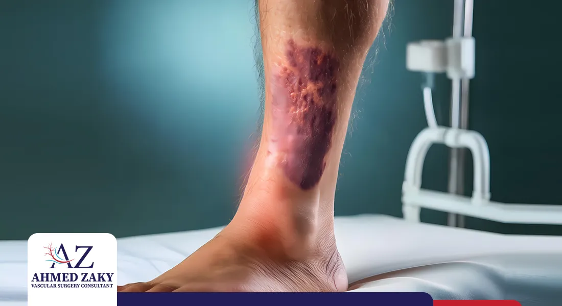 مضاعفات-قرحة-الساق-الوريدية مضاعفات قرحة الساق الوريدية
