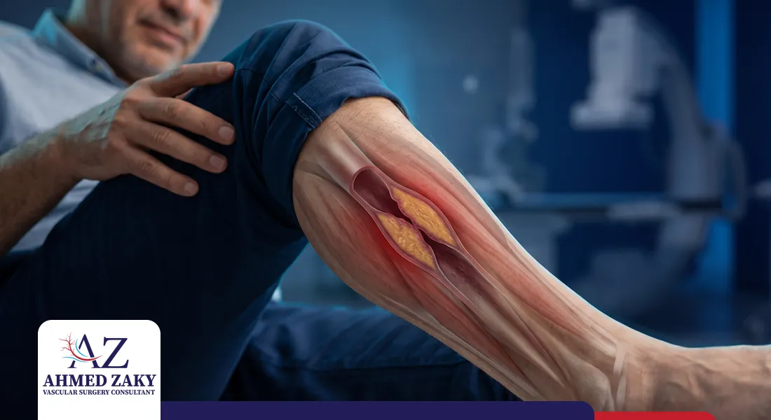 علاج تصلب شرايين الساق
